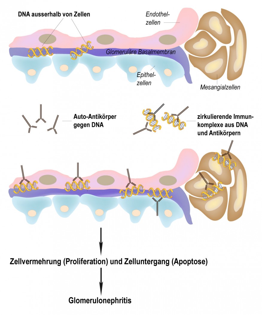Systemischer Lupus Erythematodes - Rheumaliga Schweiz